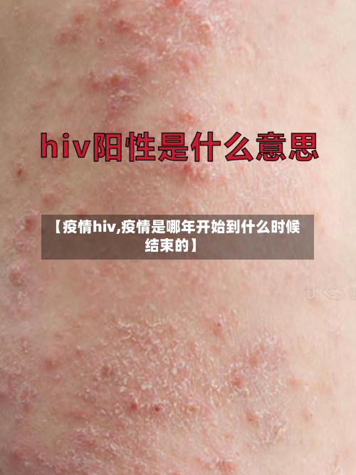 【疫情hiv,疫情是哪年开始到什么时候结束的】-第1张图片